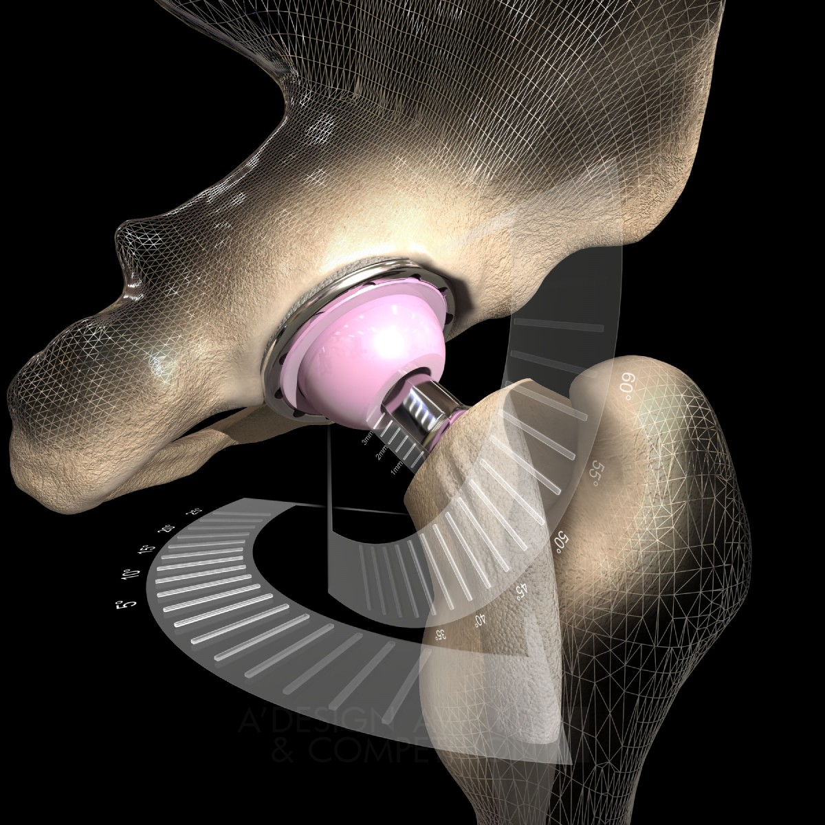 OPS™ Personalized Hip Replacement Technology by Optimized Ortho and Corin Group Silver Medical Devices and Medical Equipment Design Award Winner 2017 